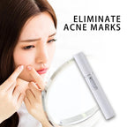 Blue Light Acne Pen: Portable Spot Treatment Device